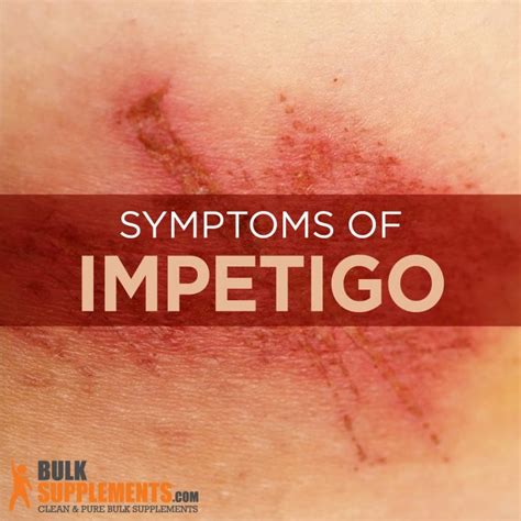 Impetigo Symptom Causes Complications And Risk Factors