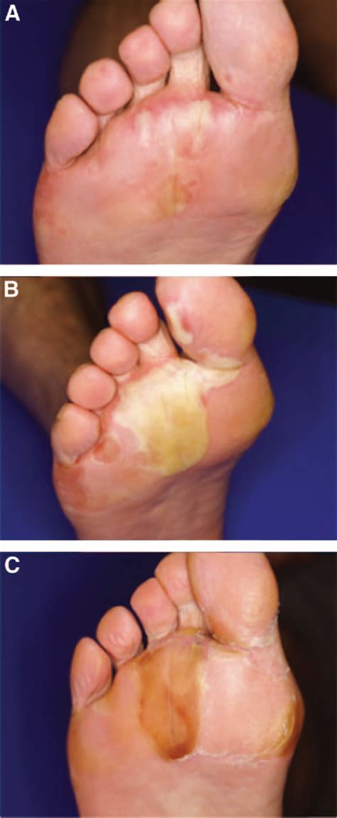 Table 2 From Clinical Presentation And Management Of Hand Foot Skin