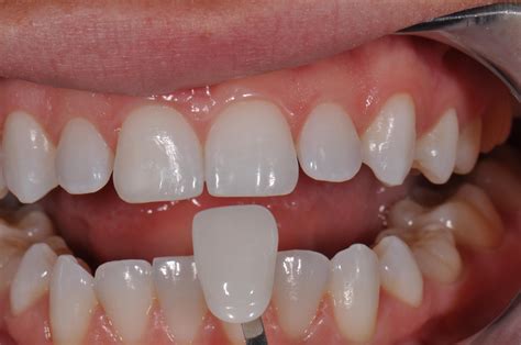 Researchers Create A High Viscosity Sla 3d Printer That Can Print Teeth