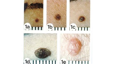 Skin Cancer And Raised Or Elevated Moles Howcast