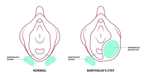 Bartholin’s Cyst Causes Symptoms And Removal Andrew Krinsky Md Facog
