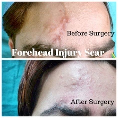 Injury Scar How To Remove A Forehead Skin Scar By Plastic Surgery