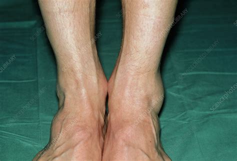 Swollen Ankle Sprain