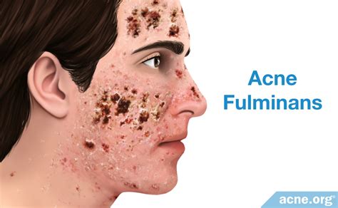 What Is Cystic Acne