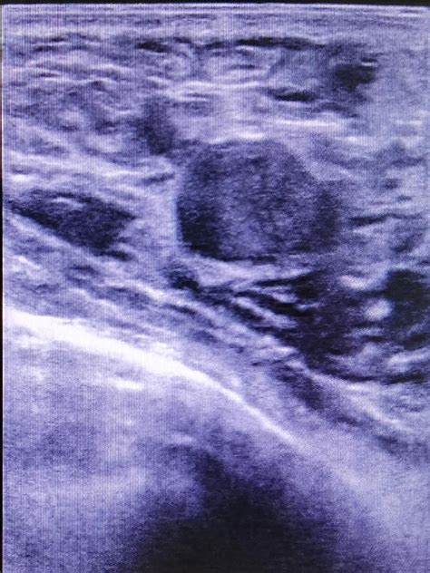 Figure 1 From Clinical Value Of Ultrasound Guided Minimally Invasive