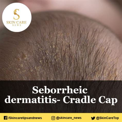 Seborrheic Dermatitis Cradle Cap
