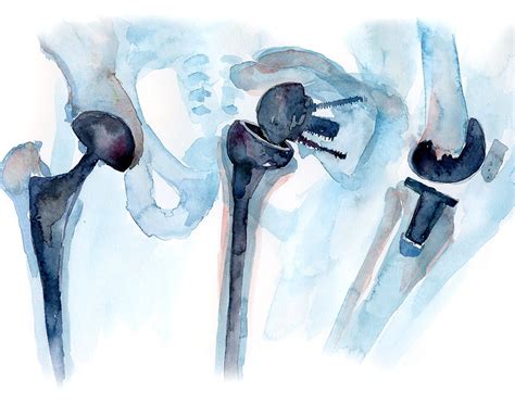 Orthopedics Watercolor Print Orthopedic Surgery Art Etsy Orthopedic