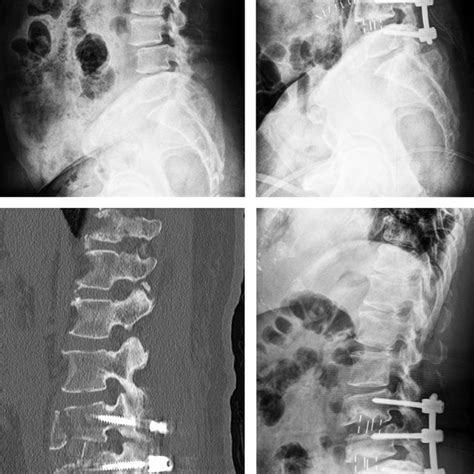 A Preoperative And B Immediate Postoperative Lateral Radiographs Of
