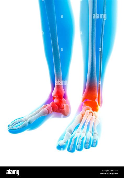 Human Inflamed Ankle Illustration Stock Photo Alamy
