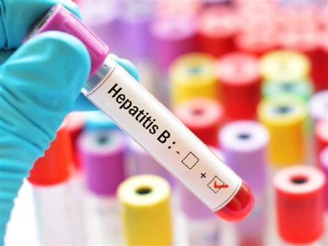 Hepatitis B Guía Sobre Diagnóstico Y Tratamiento Fundación Hcv Sin