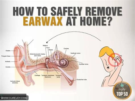 How To Safely Remove Earwax At Home Earwaxbuildup Ear Wax Ear