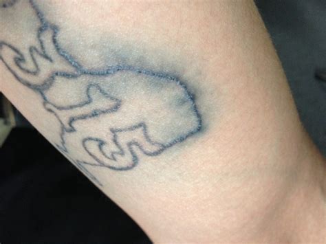 What Is Tattoo Blowout & Can You Fix It? | AuthorityTattoo