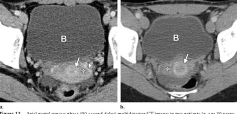 figure 12 from normal or abnormal demystifying uterine and cervical contrast enhancement at