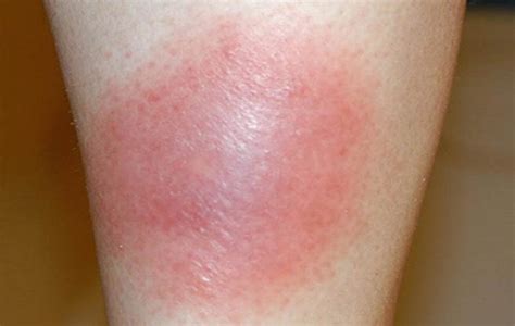 10 Signs And Symptoms Of Mrsa