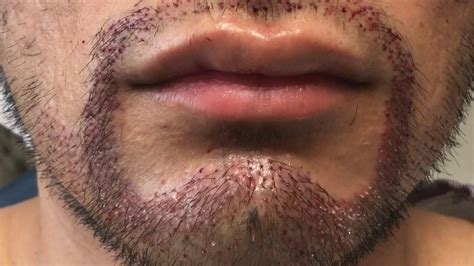 Beardfacialgoatee Mustache Hair Transplant Immediately After