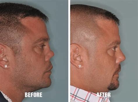 Revision Rhinoplasty Recovery Dr Anthony Bared Md Facial Plastic