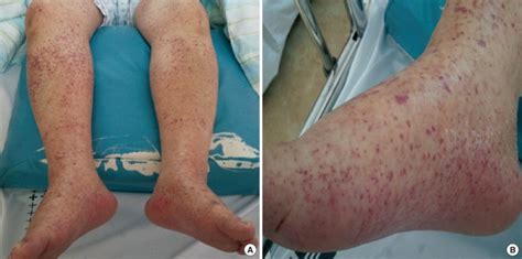 Skin Rash And Generalized Edema Were Showed On Lower Extremities