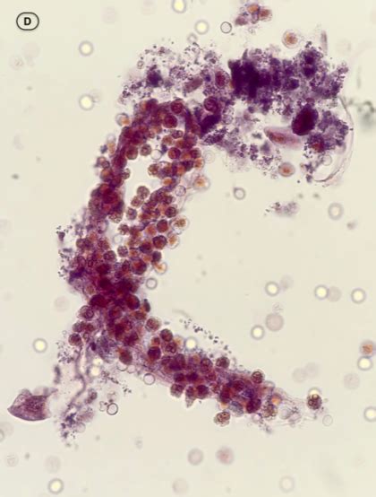 Urine Sediment Of The Month White Blood Cells Glitter Cells And