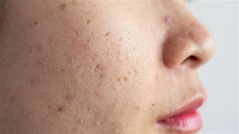 Hyperpigmentation Acne Causes And Treatment