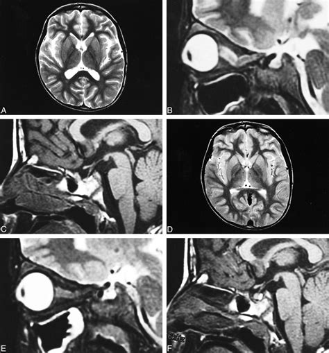 Mr Imaging Of Idiopathic Intracranial Hypertension American Journal