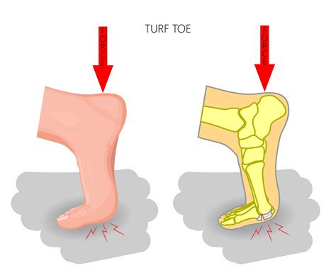 Turf Toe A Bad Big Toe Sprain Instride Crystal Coast Podiatry