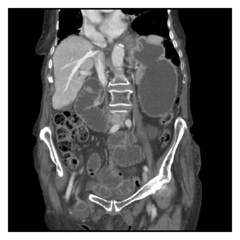 Ct Abdomen And Pelvis Coronal View With Iv Contrast Illustrating Right