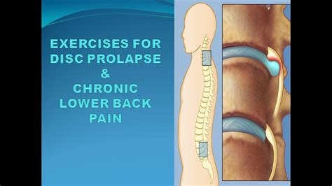 Exercise For Disc Prolapse Top 5 Exercise For Low Back Painenglish