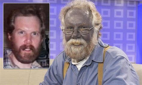 Man Turns Blue After Self Medicating Colloidal Silver Colloidal