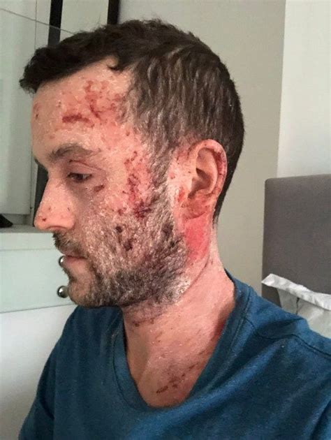 Man Is Treating His Severe Eczema By Drying Out His Skin Flaky Skin