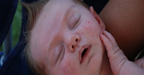 Causes And Treatments For Baby Acne