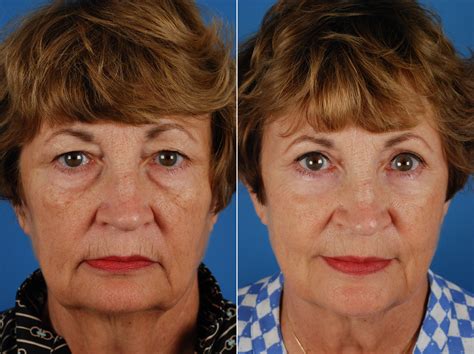Upper Eyelid Blepharoplasty Before After Photos Patient Langley My