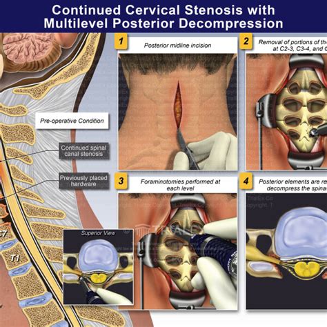 Continued Cervical Stenosis With Multilevel Posterior Decompression