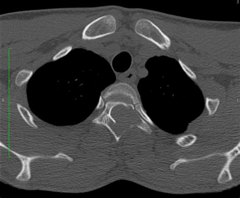 Vertebral Aneurysmal Bone Cyst Image