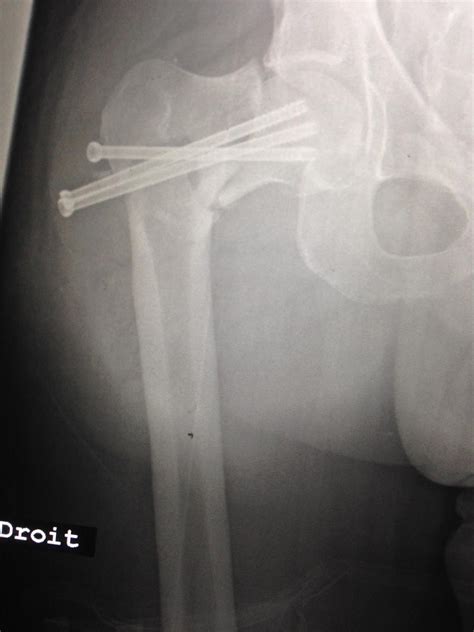 Femoral Neck Fractures Trauma Orthobullets