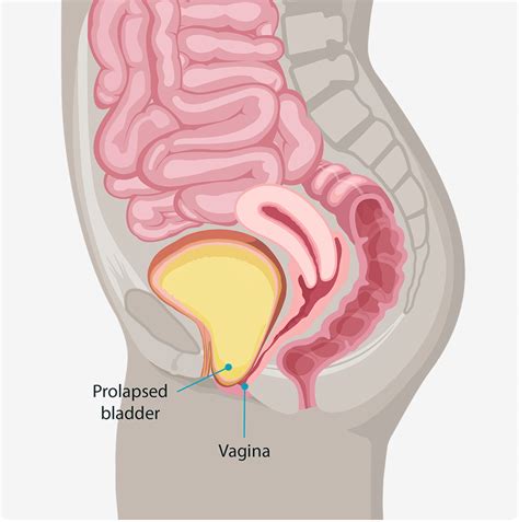 Surgical Solutions For Prolapse Female Pelvic Solutions