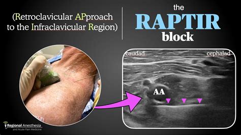Raptir Block Retroclavicular Approach To The Infraclavicular Region