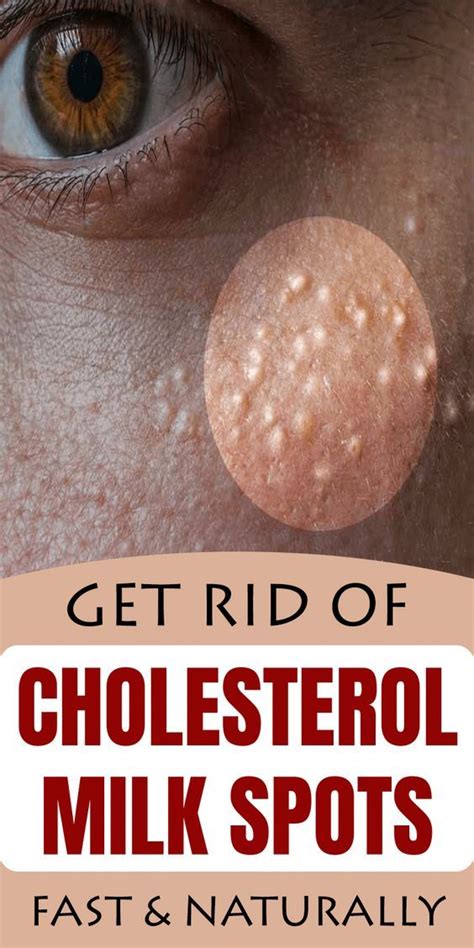 7 Remedies To Get Rid Of Cholesterol Milk Spots Naturally Skin