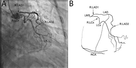 Coronary Angiogram And Schematic The Coronary Angiogram Is Shown In