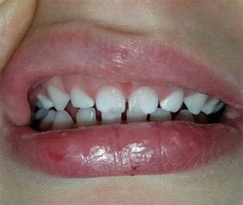 3 Yo White Discoloration On Teeth Pic Babycenter