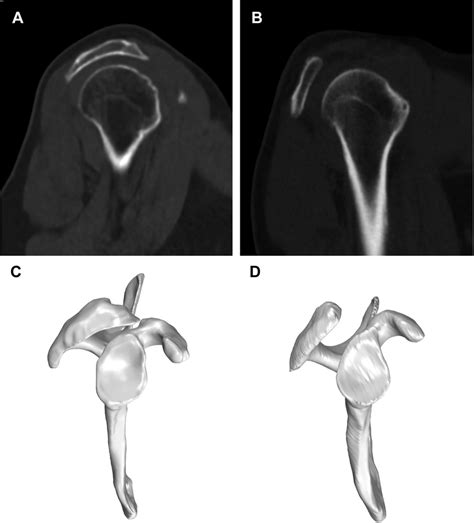 Scapular Morphology Based On Ct Scan Images And Corresponding