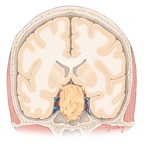 Pituitary Macroadenoma The Neurosurgical Atlas