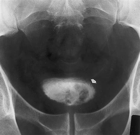 Intravenous Urography Technique And Interpretation Radiographics