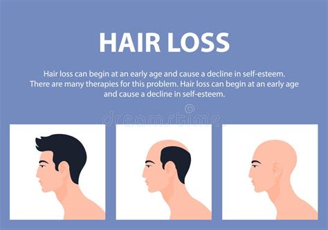 Stages Of Baldness Of Men Male Characters Head Top And Side View With