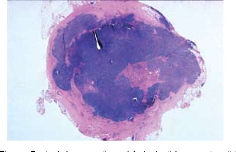 Figure 1 From Collision Tumor Concurrent Involvement Of Virchows Lymph