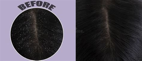 Before And After Dandruff Treatment Shampoo On Hair Woman Dandruff In