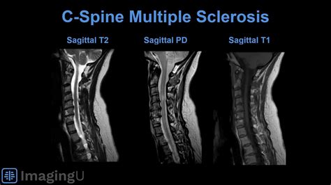 Imagingu Multiple Sclerosis Ms Is A Demyelinating Facebook