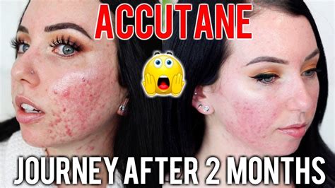 My Accutane Journey 2 Month Update Before And After Side Effects Skin