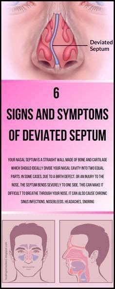Deviated Septum Headache Headache