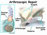 Photos of Recovery From Biceps Tenodesis Arthroscopy Surgery