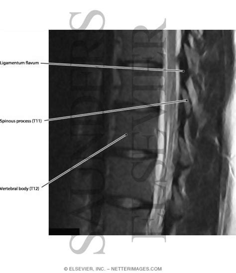 Ligamentum flavum buckling is a result of a weakened ligamentum flavum, or the ligaments in your vertebrae that allow for bending over and snapping back up. Ligamentum Flavum
